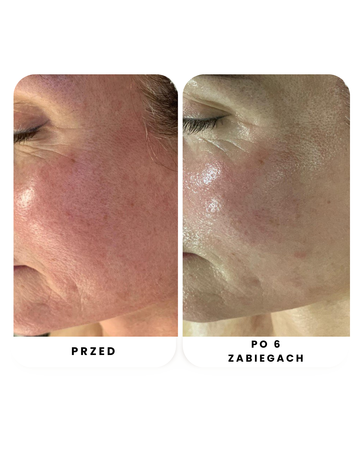 Zestaw Anti-Couperose VEDARA MEDICAL